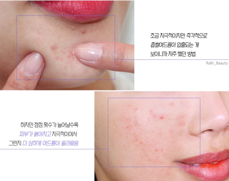 좁쌀 여드름 없애는 방법을 공유하다 7