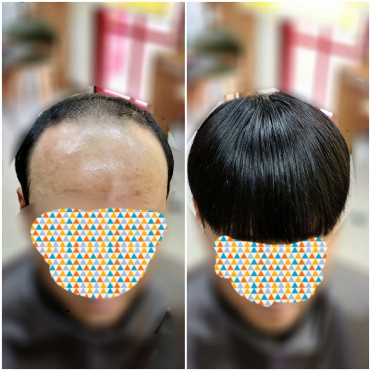  당신이 헤어이식커버증모술로 체인지 해야만 하는 6가지 이유[춘천가발 ㆍ보톡스증모술전문점]