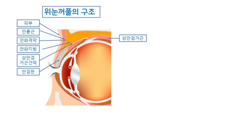  눈두덩이 지방 제거 자연유착쌍수로는 절대할 수 없나?