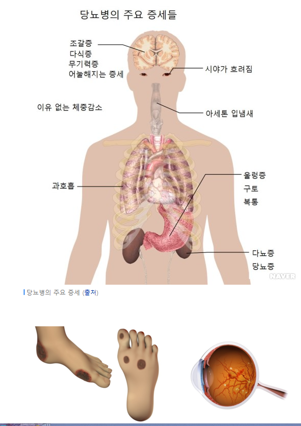 당뇨병