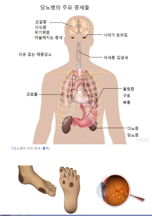 당뇨병