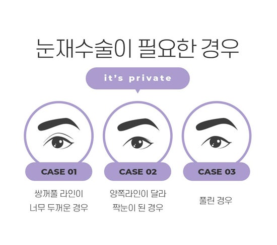쌍수 재수술은 프라이빗성형외과 사진 3