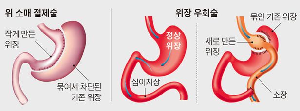 1년에 고도비만 2500명이 위 절제…건강보험 적용 후 5배 늘었다 1년에 고도비만 2500명이 위 절제…건강보험 적용 후 5배 늘었다