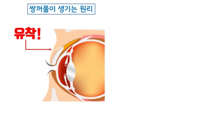  쌍수 실밥제거 후 쌍꺼풀 실 없음, 레알?