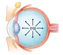 눈안구질환 백내장녹내장 비교차이점 원인증상치료: 약물종류 인공수정체수술 안압감소