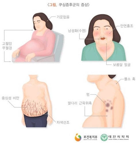 유사암의 종류와 암보험의 보장범위를 비교한다(갑상선암, 제자암, 경계성종양, 기타 피부암)
