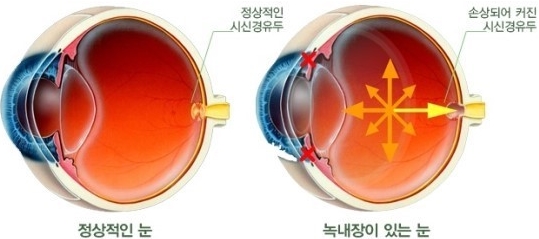  녹내장 있는데 백내장 수술! 시력교정 수술! 가능할까요?