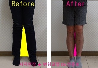  엑스다리 X다리 교정