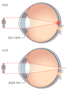 노화안구질환 노안원인증상 치료방법 수정체망막이상: 시력감퇴 늦추는 법