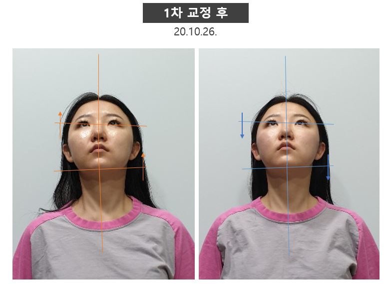 안면비대칭 교정 10회차 후기) 1