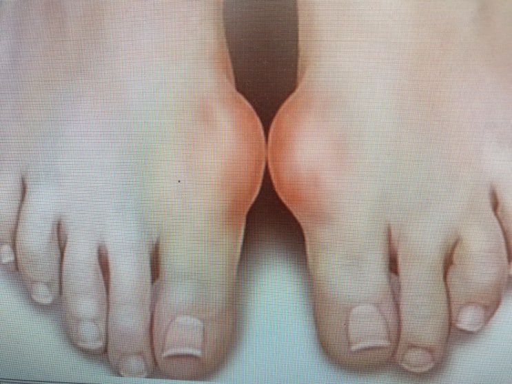  통풍에 좋은 음식!