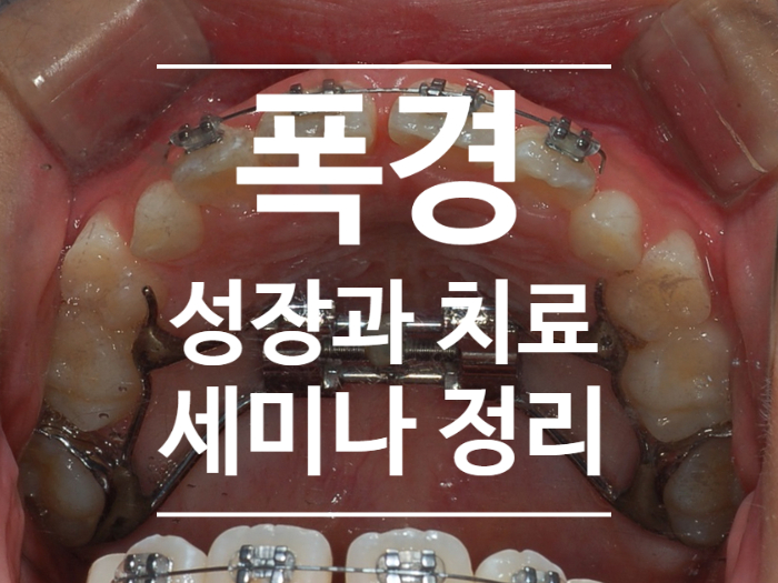 치아교정) 횡적인 문제에 대한 진단과 치료 세미나 정리