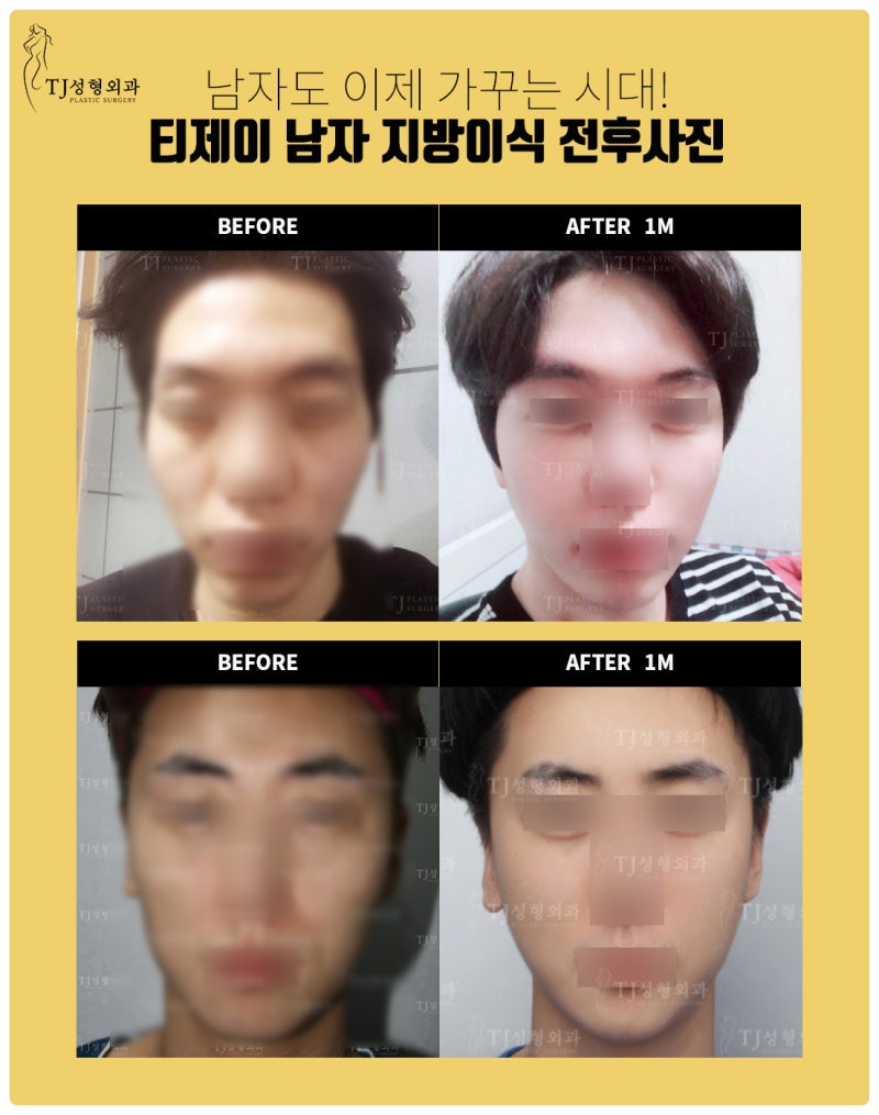 여자 풀페이스지방이식과 남자지방이식의 차이! 티제이성형외과만의 특별한 얼굴지방이식! : 네이버 블로그 여자 풀페이스지방이식과 남자지방이식의 차이! 티제이성형외과만의 특별한 얼굴지방이식! : 네이버 블로그