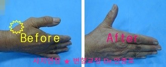 손가락 마디 통증과 손가락 관절염