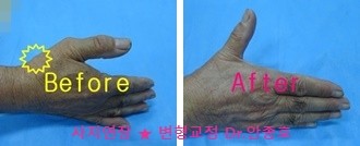  손가락 마디 통증과 손가락 관절염