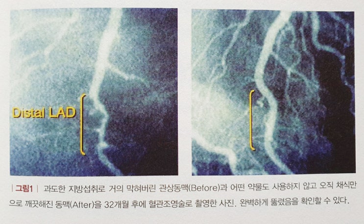  채식주의, 빌클린턴의 인생을 바꾸다 (콜드웰에셀스틴)