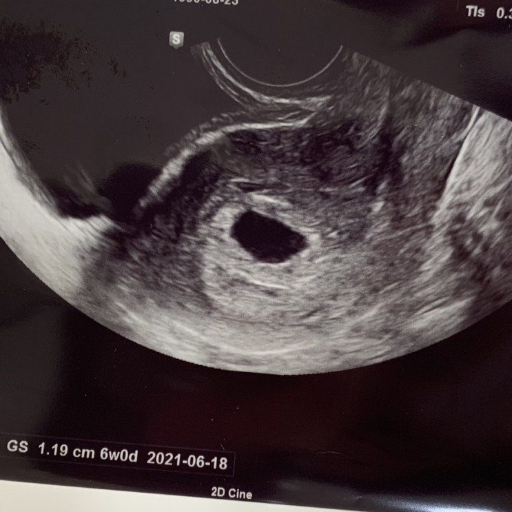 [임신일기] 입덧의 시작 (6주 0일)