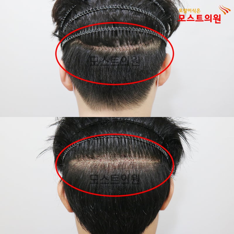 마산모발이식절개와 비절개의 차이를 고려하여
