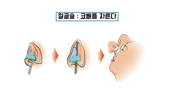  코절골로 넓은코 제대로 교정 가즈아!!!