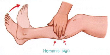 Deep Vein Thrombosis 심부정맥혈전증 네이버 블로그 Deep Vein Thrombosis 심부정맥혈전증 네이버 블로그
