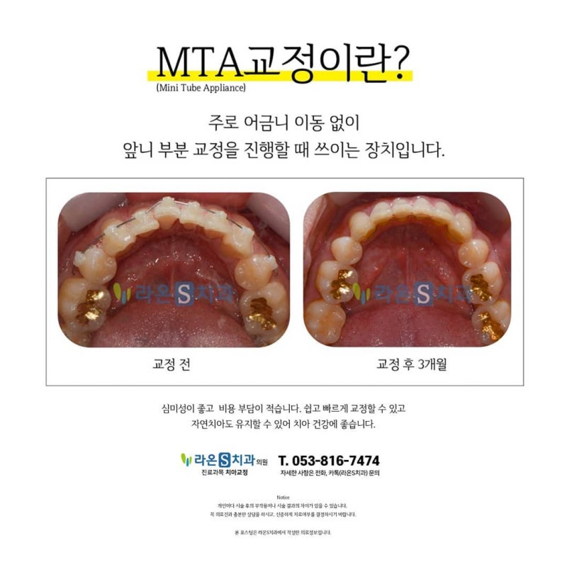 청소년 교정 치료는 성장기에 있어 발육 상태가 다릅니다.개인에게 구강 상태를 파악하고 면밀히 분석하여 교정 치료를 하는 동안 꼼꼼히 살펴야 합니다.경산 치아교정 청소년 치료는 교정 전후를 고려하여 비교해야 합니다.진단을 통해 개인이 필요한 치료와 치아 상태를 체크하고 본인에게 가장 맞는 교정치료를 결정하도록 상담합니다.어린이 교정 시기는 7세 전후로 생각하고 청소년 교정 시기는 15세 전후로 보고 있습니다.성장기 아이들은 외모에 민감하기 때문에 교정장치가 말할 때나 입을 벌릴 때 눈에 보이면 부담이 됩니다.크리PC 장치로 최소한의 노출로 교정치료를 많이 선호합니다.