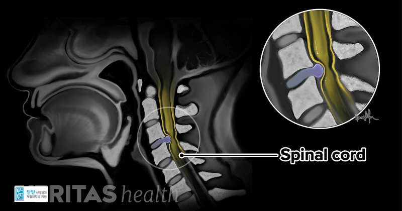 경추 척수신경병증- 경추 척수증, Cervical Myelopathy : 네이버 블로그