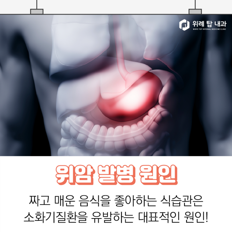 위례위내시경 위암 초기증상 위궤양과 비슷합니다! : 네이버 블로그