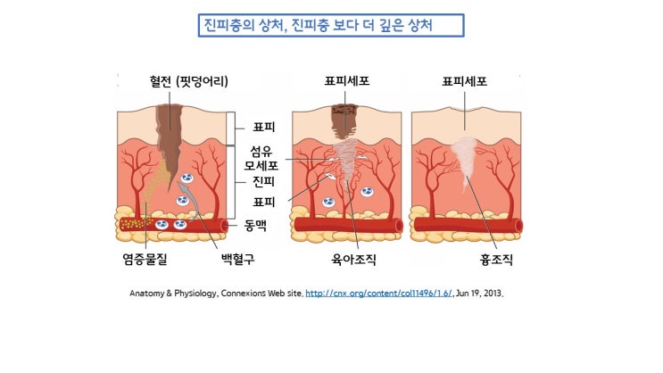 쌍수 흉터가 남지 않는 절개 쌍꺼풀 수술이 있다던데....