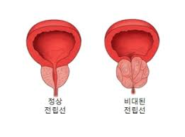 전립선비대증 남성의 대표적인문제 전립선치료방법 수술종류: 쏘팔메토 옥타코사놀 전립선비대증 남성의 대표적인문제 전립선치료방법 수술종류: 쏘팔메토 옥타코사놀