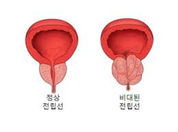 전립선비대증 남성의 대표적인문제 전립선치료방법 수술종류: 쏘팔메토 옥타코사놀