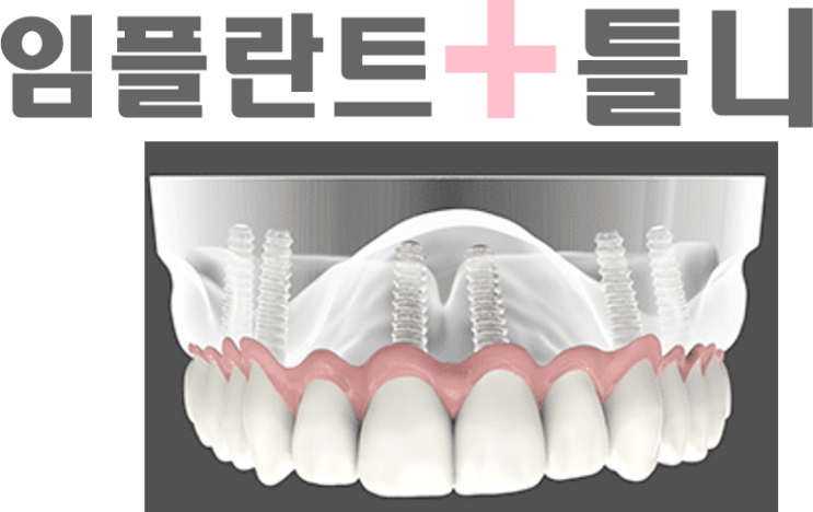  노인임플란트틀니(오버덴쳐)가격
