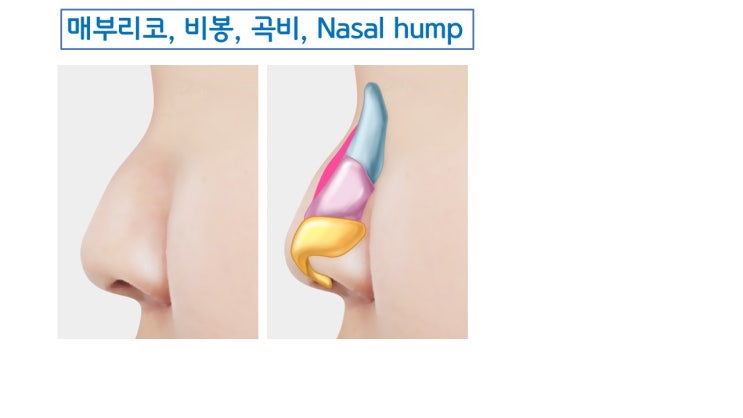  매부리코 부작용 걱정 덜어 주는 매부리코 수술 방법 딱 3가지