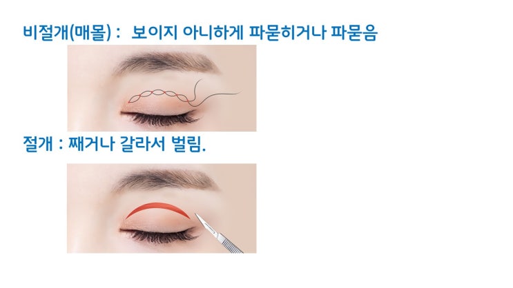  자연유착 쌍수 절대 안되는 유형 3가지