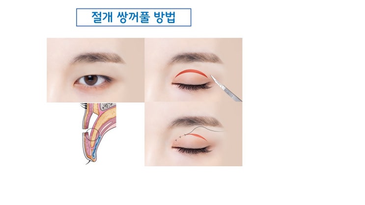  쌍수 절개 풀림은 절대로 일어날 수 없는 쌍수 부작용?