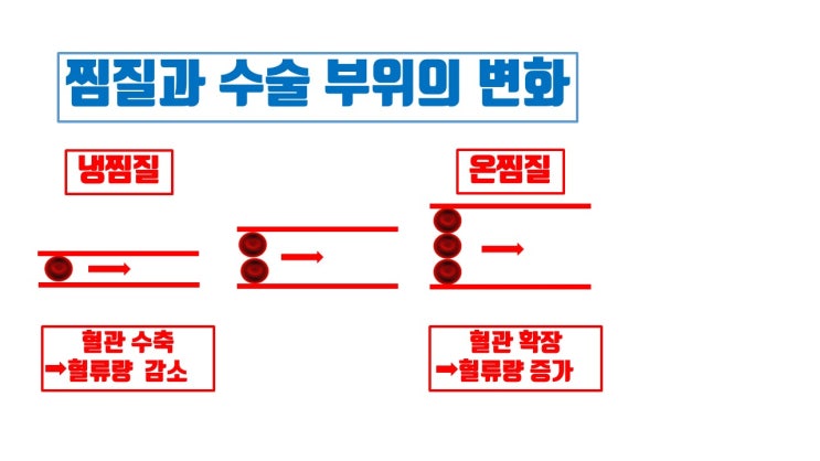  쌍수후 온찜질, 냉찜질 쌍수후 멍, 붓기 감소 위해 반드시!!!