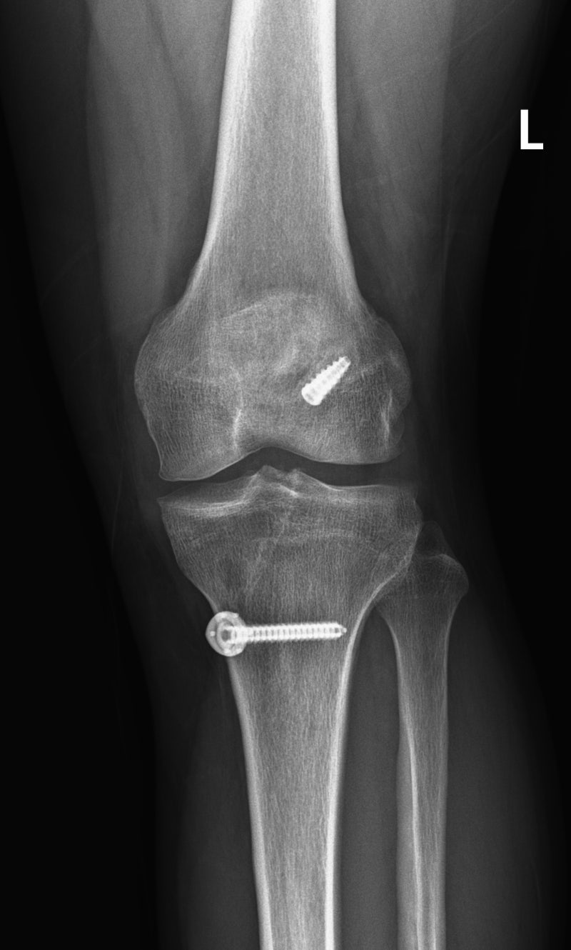 전방십자인대 재건술 후 다시 파열되었어요, 전방십자인대 재건술 재수술 (revision ACL reconstruction ...