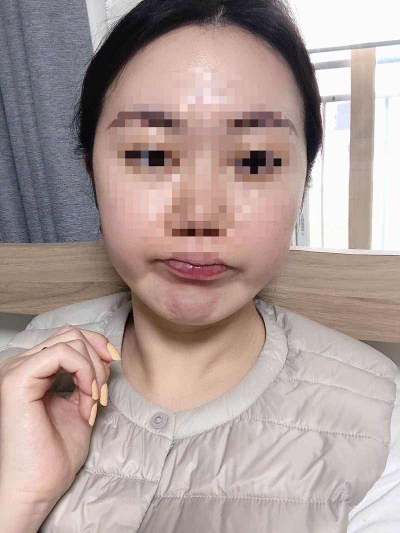 (부산 보조개 수술) 보조개 수술 솔직사진/뱀에 물린 흉터/사진첨부/4년 후