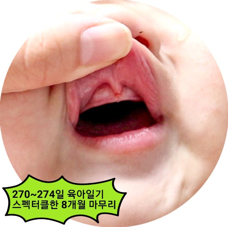  육아일기 8개월아기 윗잇몸 순소대 찢어짐 소독 모기물집까지