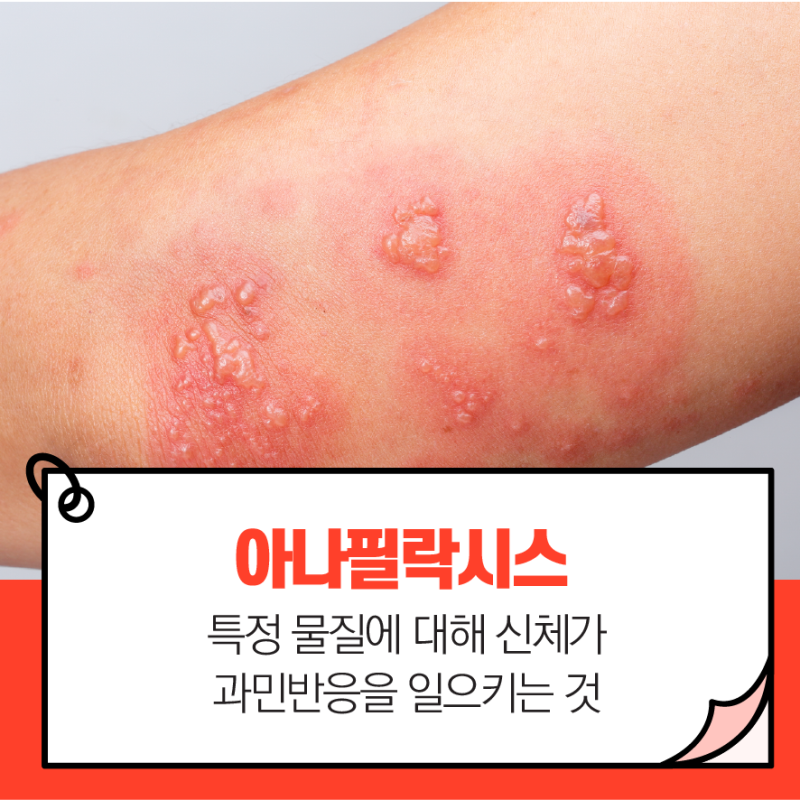 아나필락시스 의미 두통 오한 알레르기 아나필락시스 쇼크 의미 간략한 요약 5
