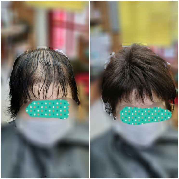  가발 벗고 보톡스증모술 한 것엔 이유가 있다!  [춘천가발 ㆍ보톡스증모술전문점]