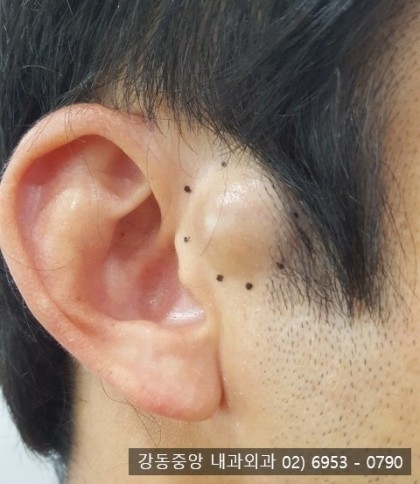 귀 앞쪽 피지낭종 제거 수술, 귀 앞 혹이 생겼어요 (천보성 외과) : 네이버 블로그
