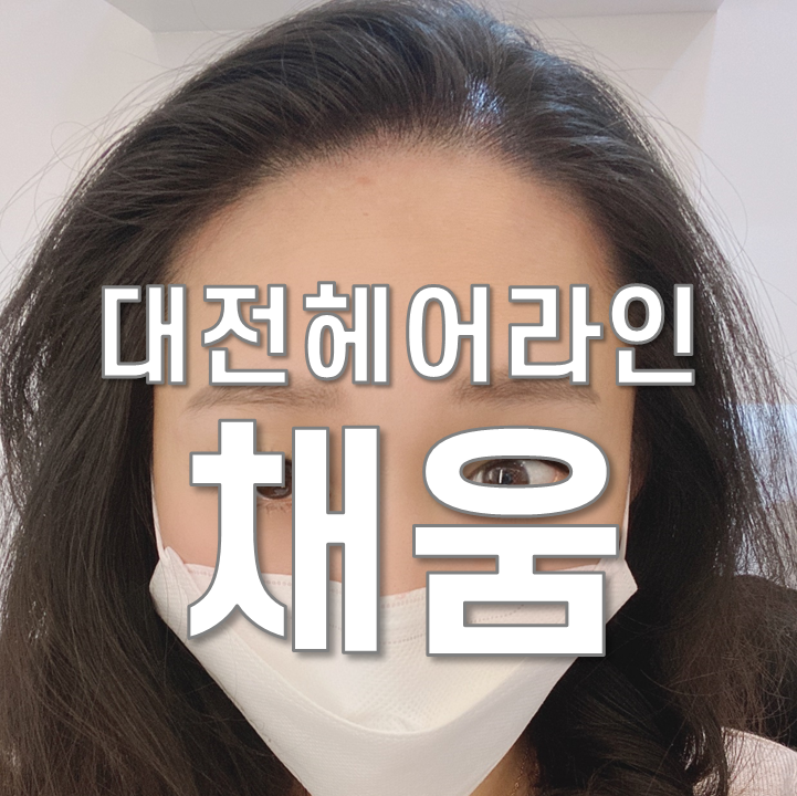  대전 둔산동 헤어라인 두피관리 채움에서 SMP