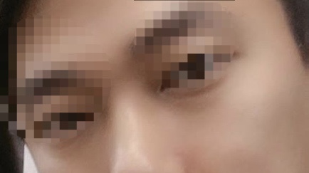  상담후기 :) 눈밑지방재배치 잘하는 곳