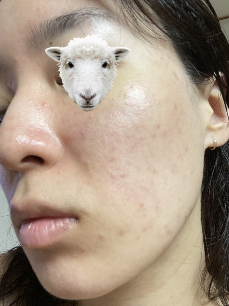 이소티논 피지억제제 한달 복용기