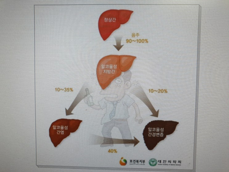  지방간에 안 좋은 음식과 좋은 음식!