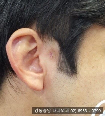 귀 앞쪽 피지낭종 제거 수술, 귀 앞 혹이 생겼어요 (천보성 외과) : 네이버 블로그