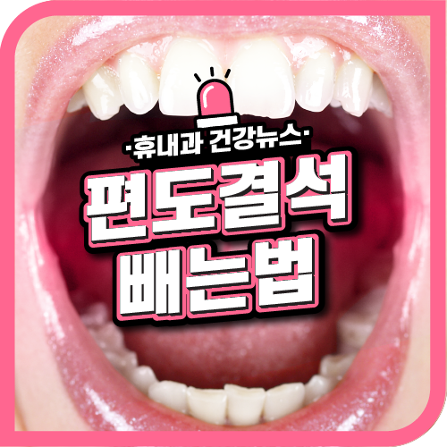  편도결석 빼는법 원인과 냄새로 진단하기!
