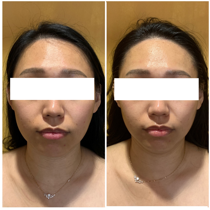  청주 금천동 피부관리] 힐링자연치유 작은얼굴 되었어요~
