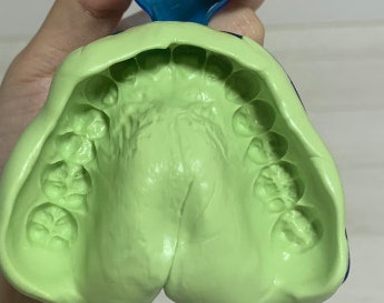 수면 마우스피스 티스 한달후기