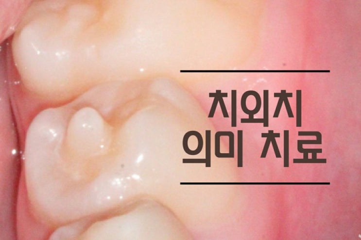 치외치 :: 치아형태이상 기형치 의미와 치료 방법